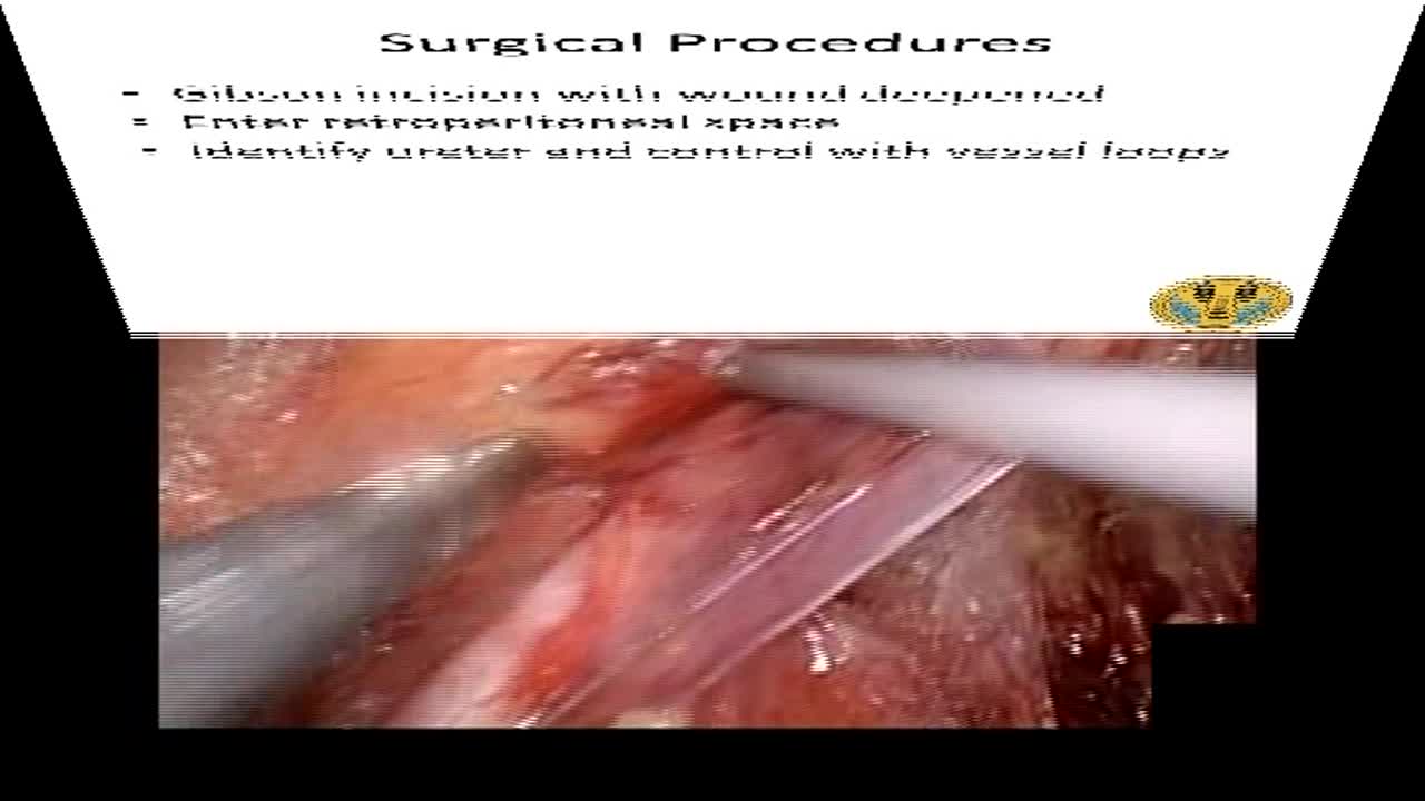 A novel approach for LESS nephroureterectomy for upper ur..-