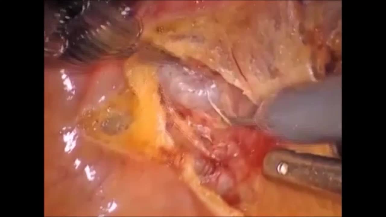 Salvage robotic-assisted laparoscopic prostatectomy (sRARP)