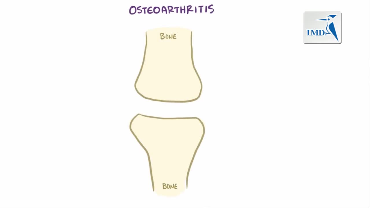 骨关节炎：病因 症状 诊断 治疗及病理学