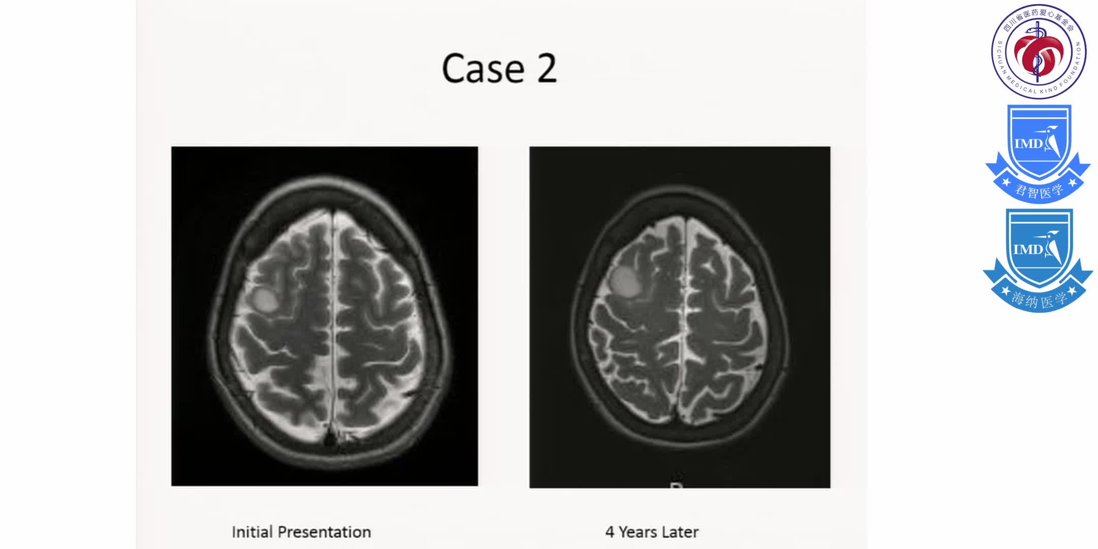 Initial Treatment, Including Scenarios Requiring Urgent and Multi-disciplinary Management for Primary Brain Tumors 3