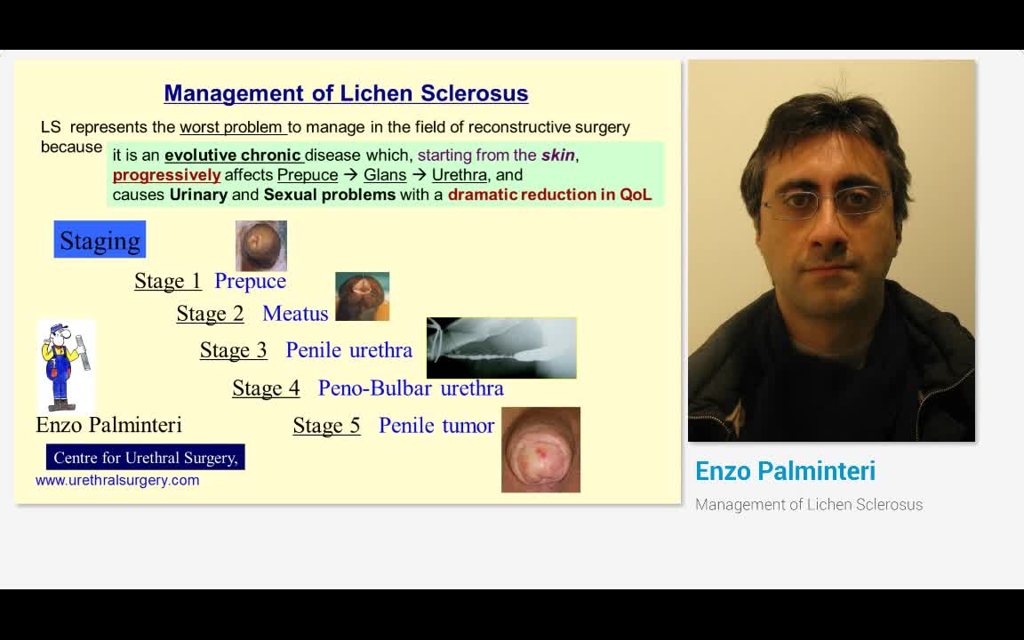 硬化性苔藓的管理