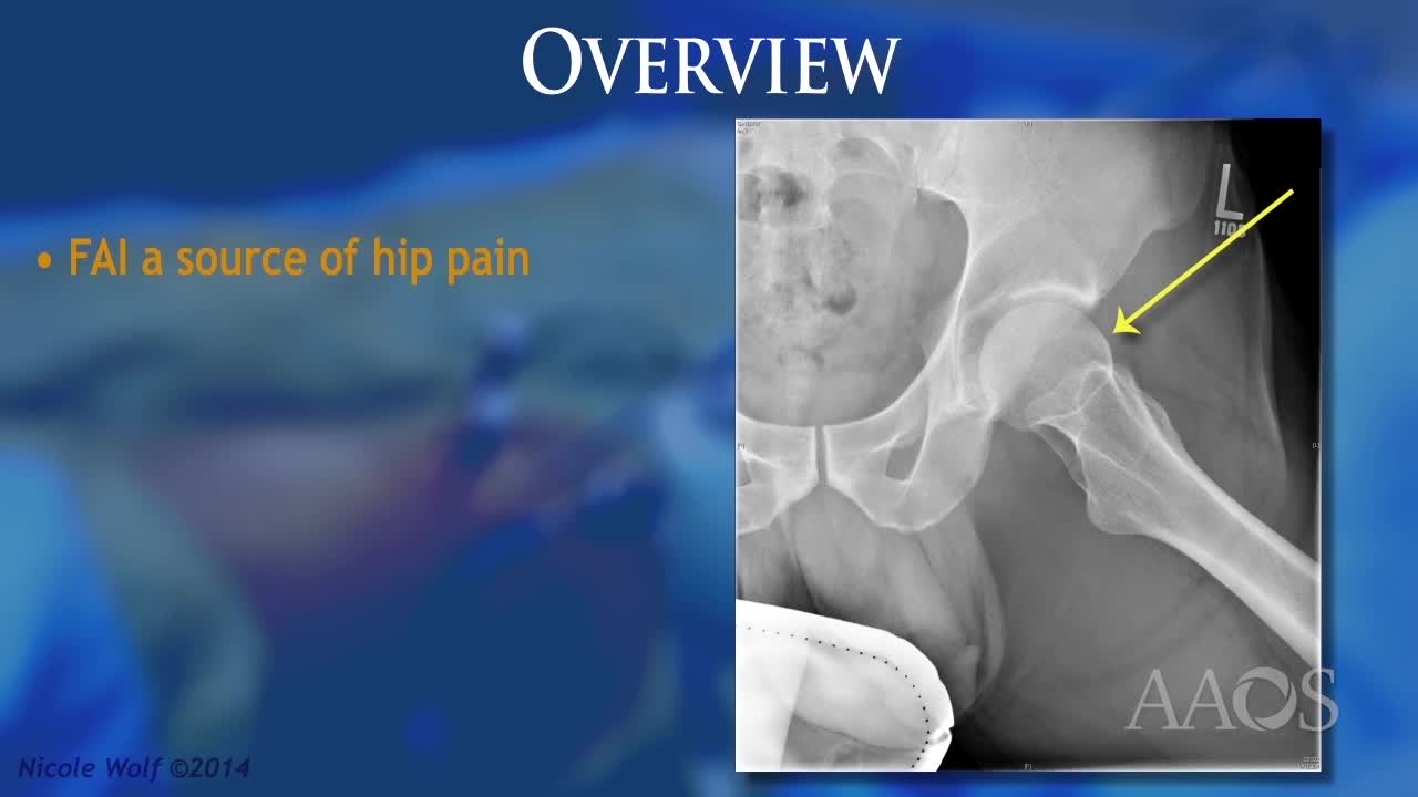 HIP ARTHROSCOPY Pitfalls & Pearls