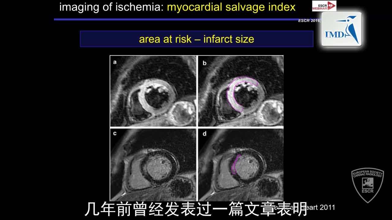 急性冠状动脉综合征发作后的影像诊断（9）