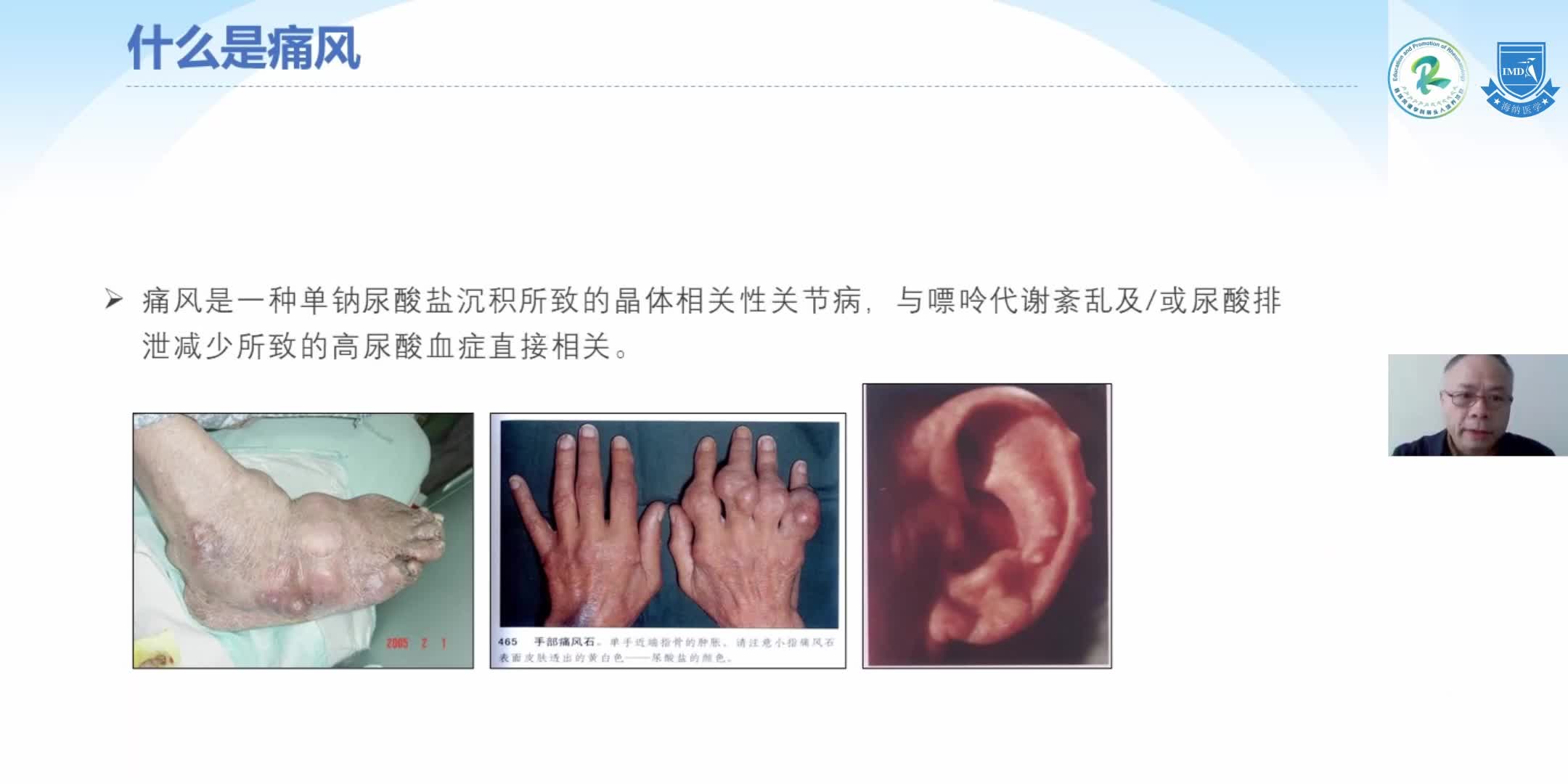 周京国-痛风性关节炎（1）