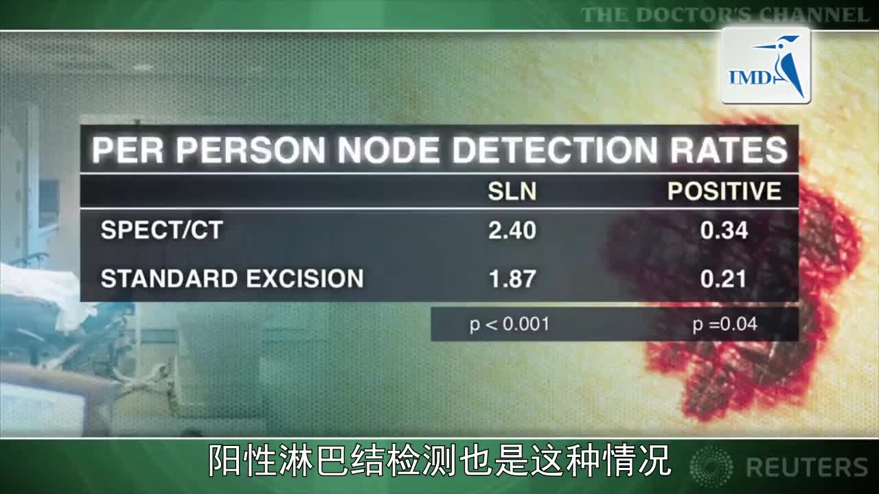 术前SPECTCT可改善黑色素瘤的管理