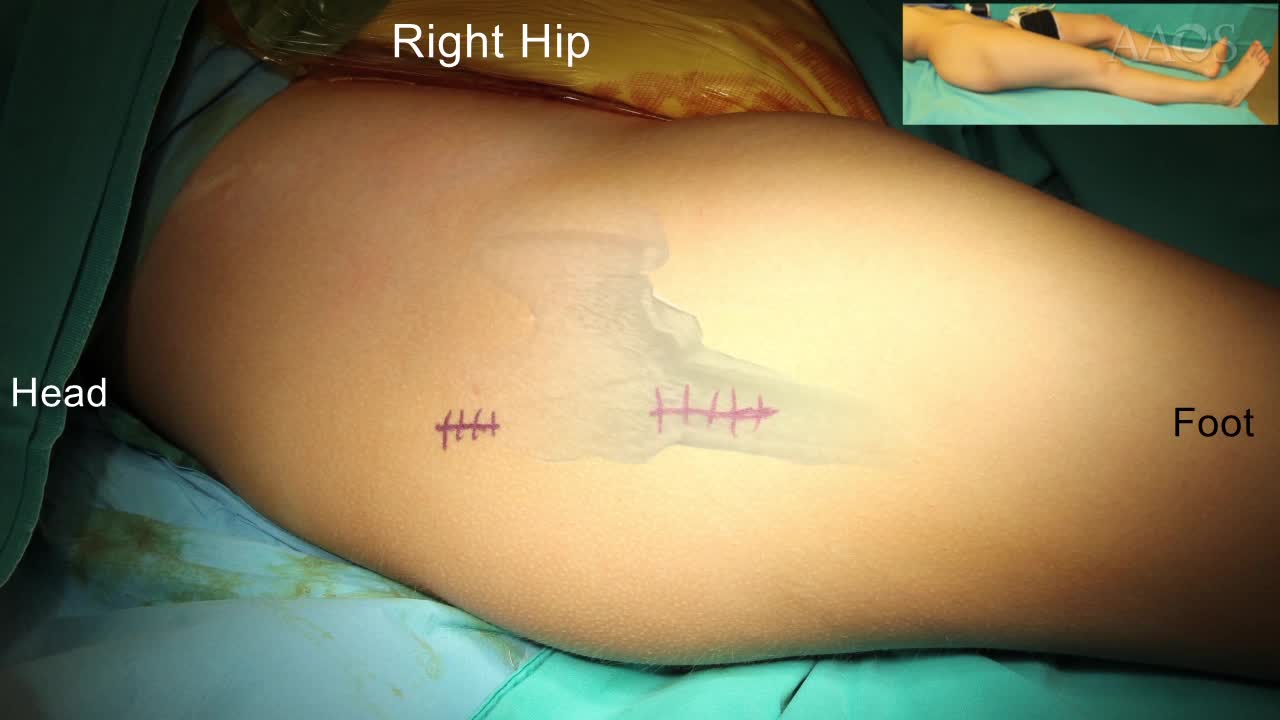 Proximal Femur Derotation OsteotomyWith Pediatric Proximal Femur NailingPediFIN