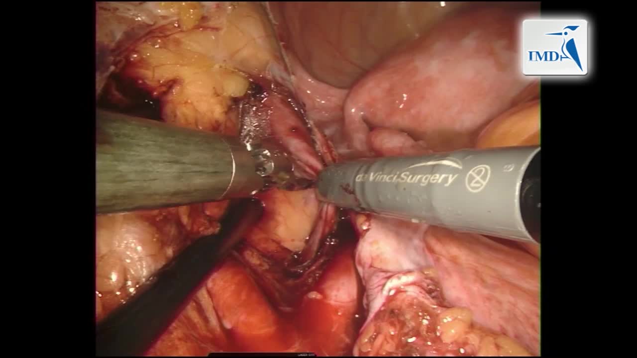经阴道肾移植机器人手术