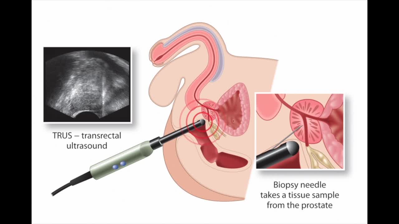 Technique and outcomes of transperineal prostate biopsy, ..-