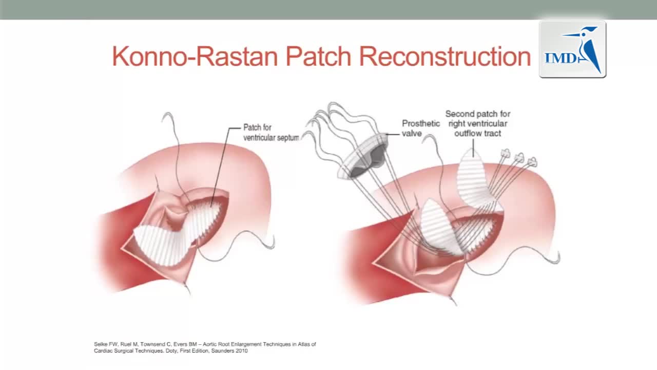 主动脉根部扩张手术（2）