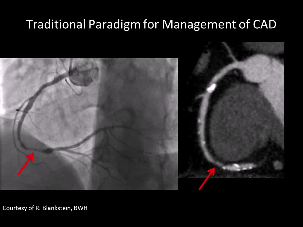 临床决策中的心肌灌注和血流