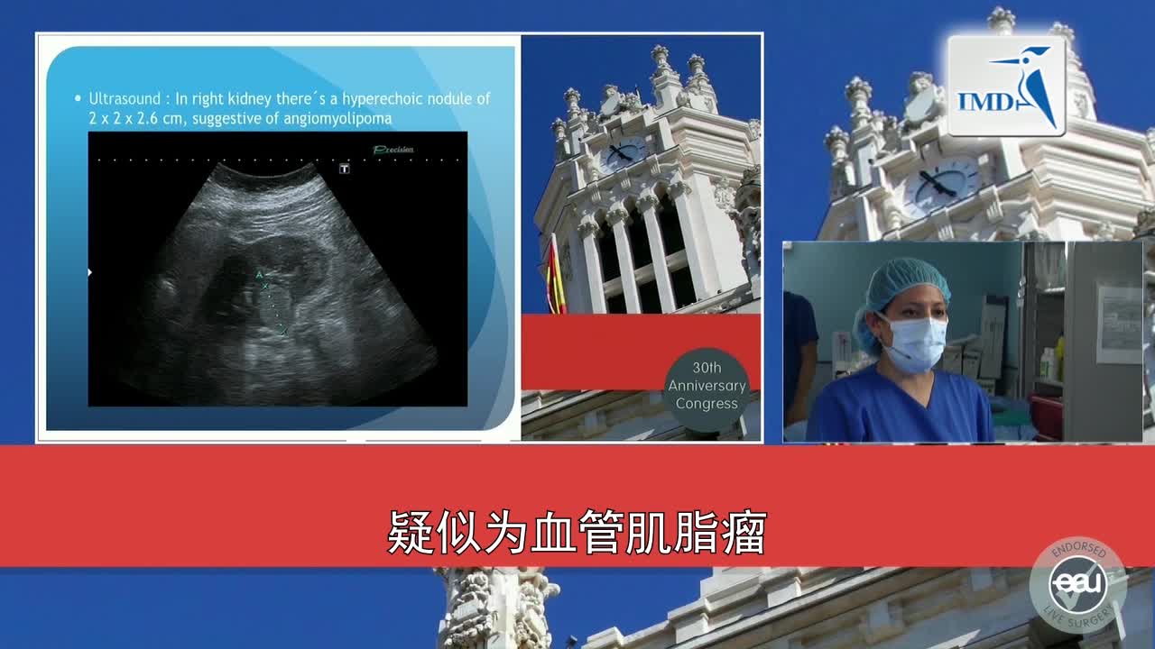 3D高清SPIES系统辅助腹腔镜部分肾切除术（1）