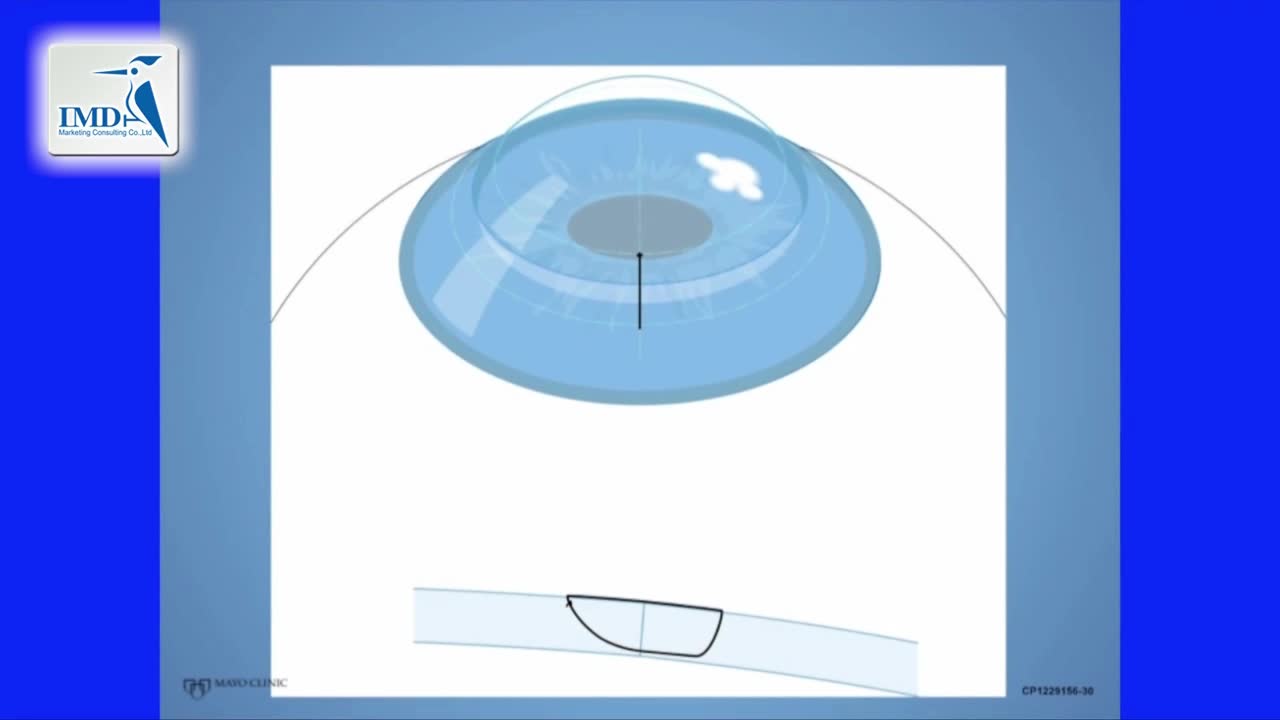 角膜缝合手术操作步骤（5）