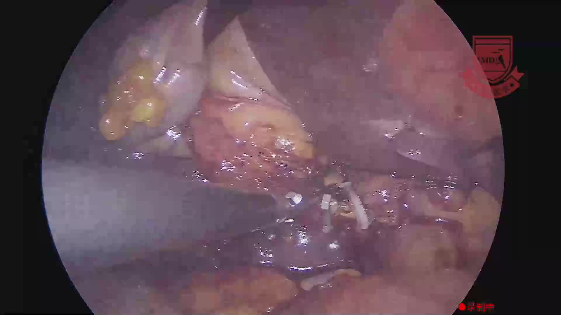 王涛--胆囊切除术