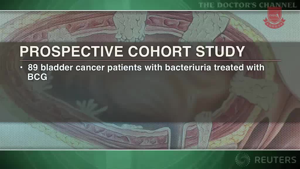卡介苗灌注可能有助于根除膀胱癌患者的菌尿症