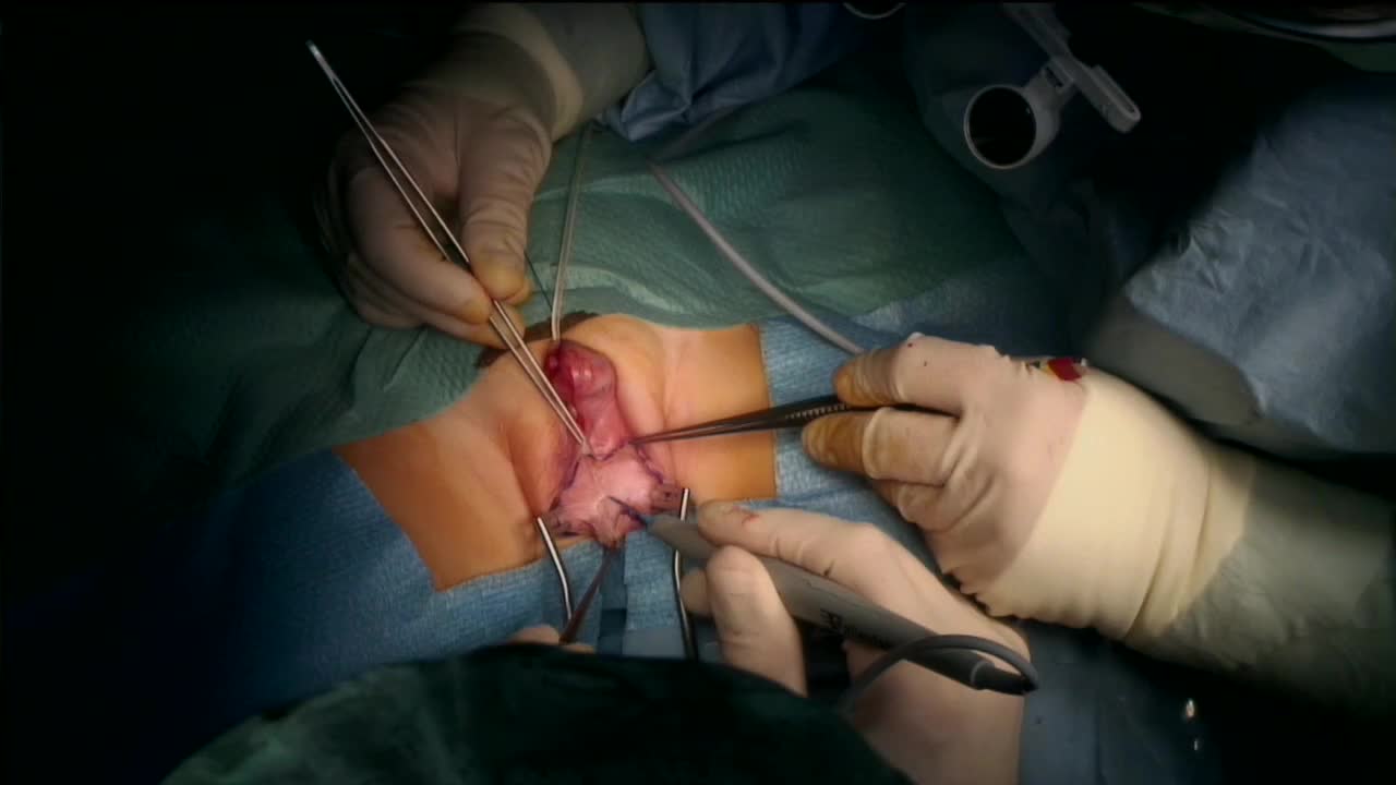 Genitoplasty in girls with adrenogenital syndrome, Focus ..-