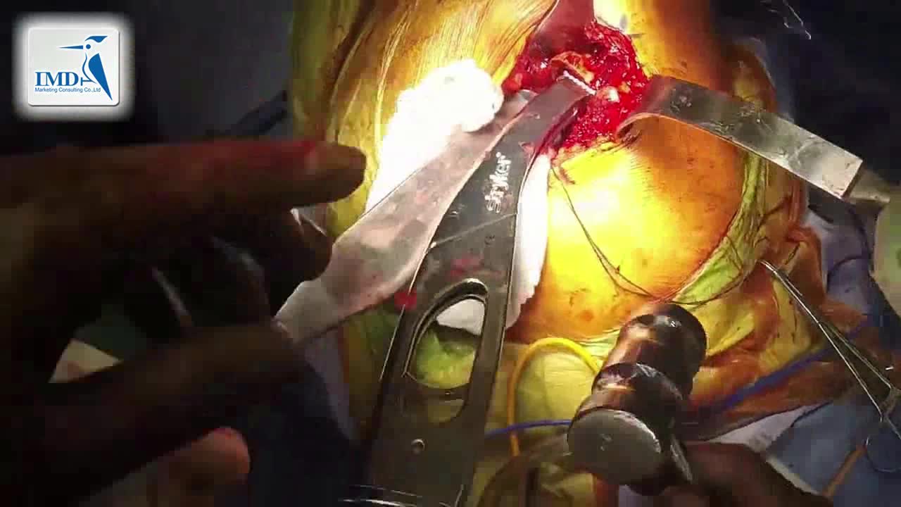 后入路髋关节微创手术（4）