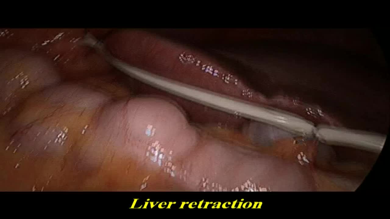 Laparoendoscopic single site plus one port ( LESS POP) ne..-