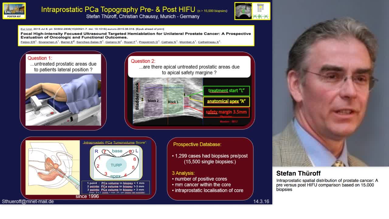 Intraprostatic spatial distribution of prostate cancer, A-