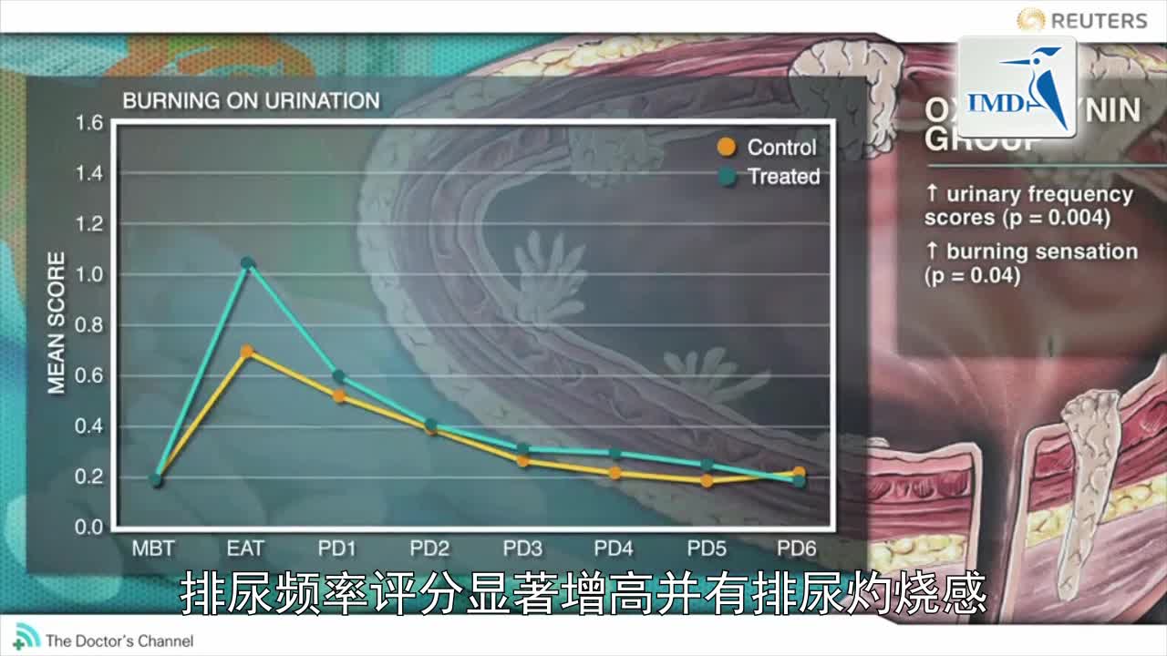 奥昔布宁矛盾性加剧膀胱内BCG疗法的副作用