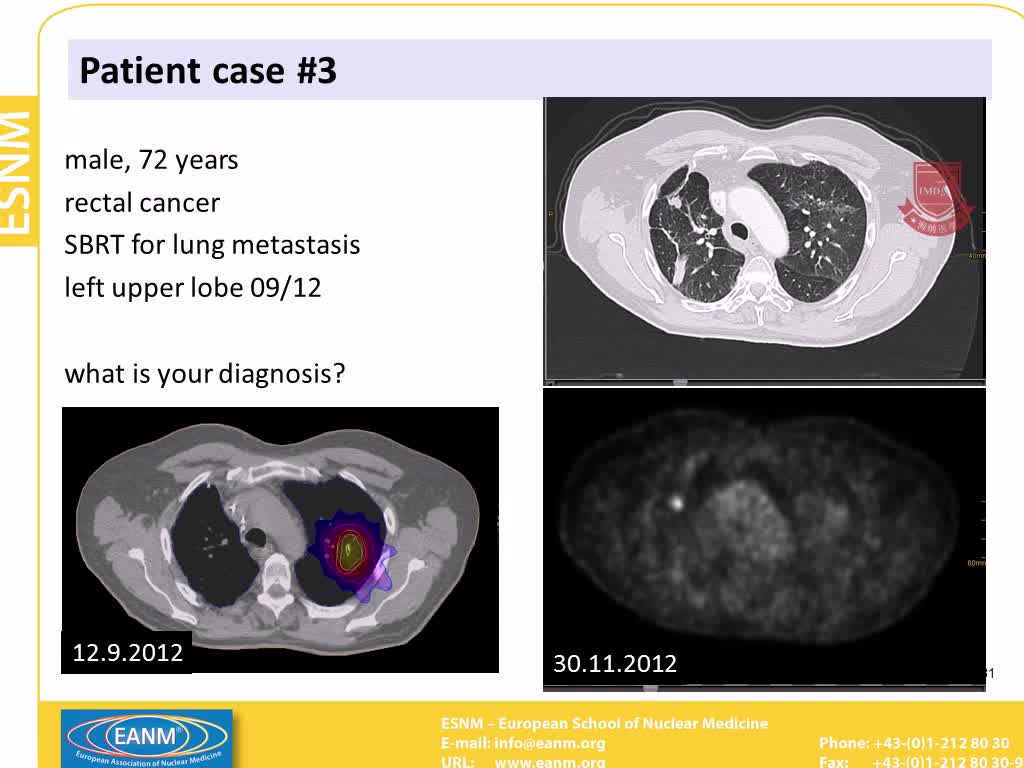 PET CT用于肺癌及其在放射治疗中的应用6