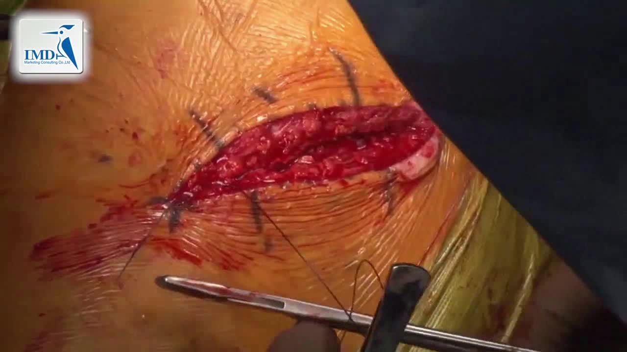 后入路髋关节微创手术（5）