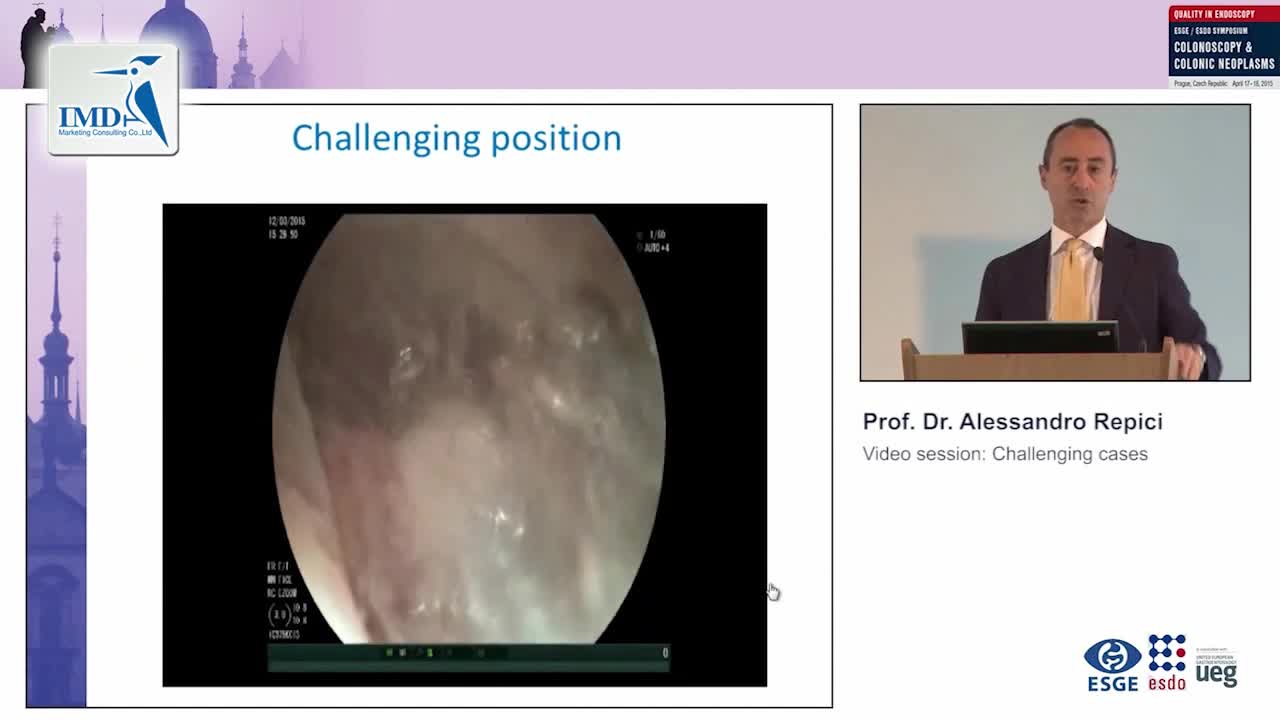 息肉切除术的挑战（1）