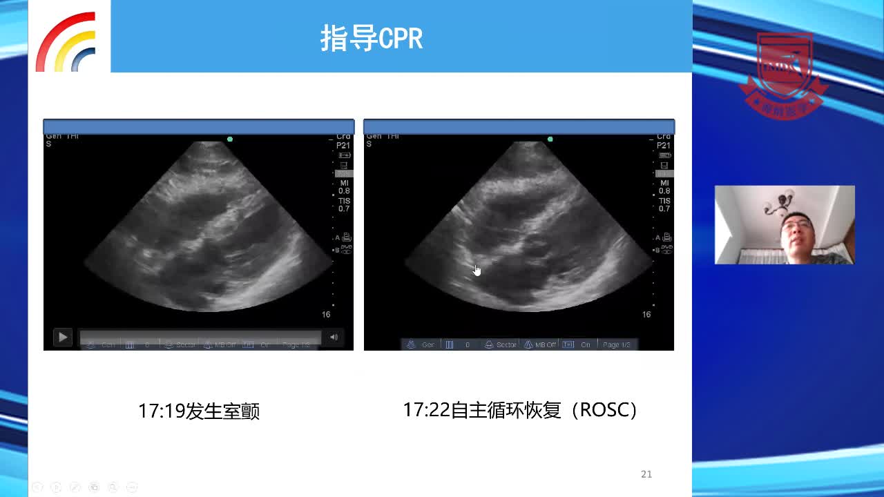 床旁超声助力心肺复苏--尚游（2）