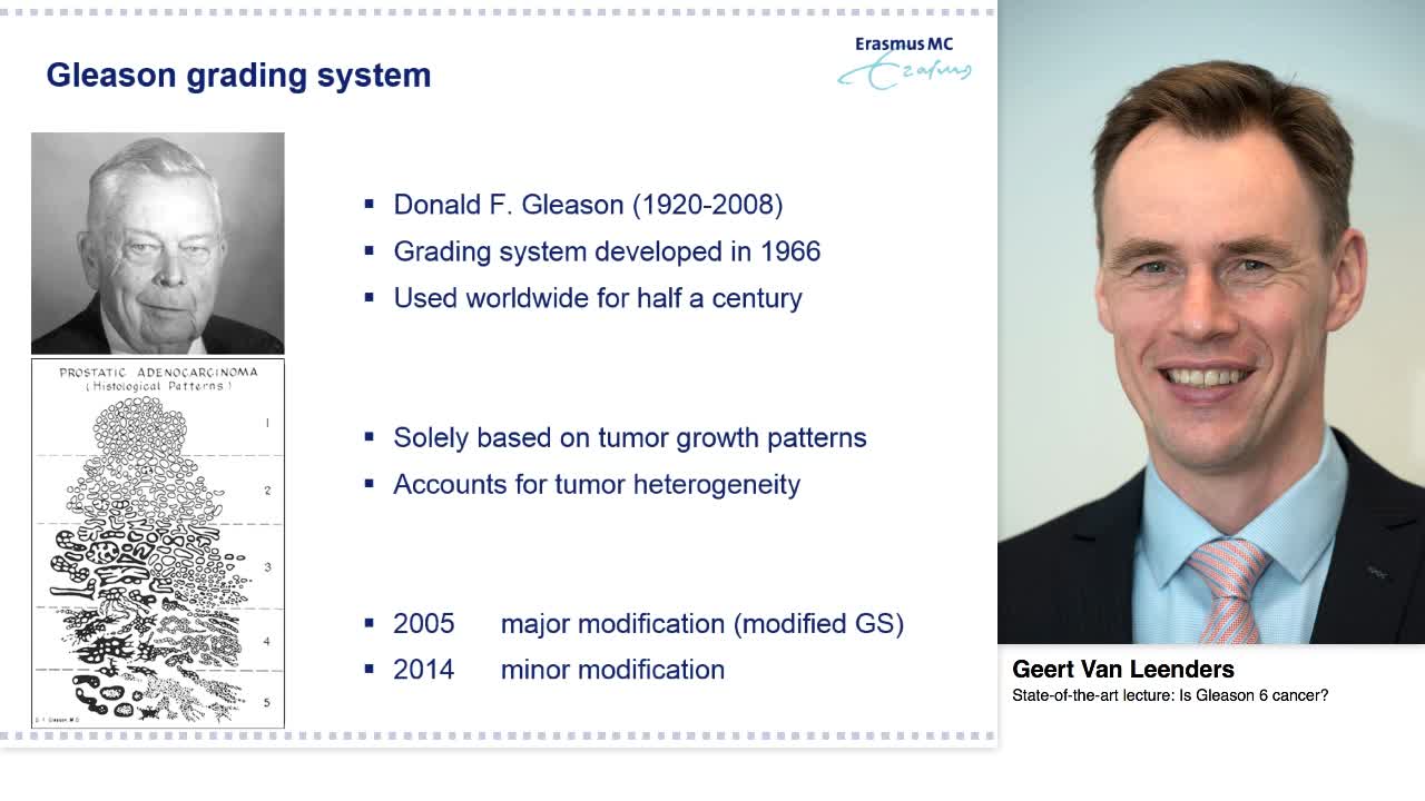 Is Gleason 6 cancer.