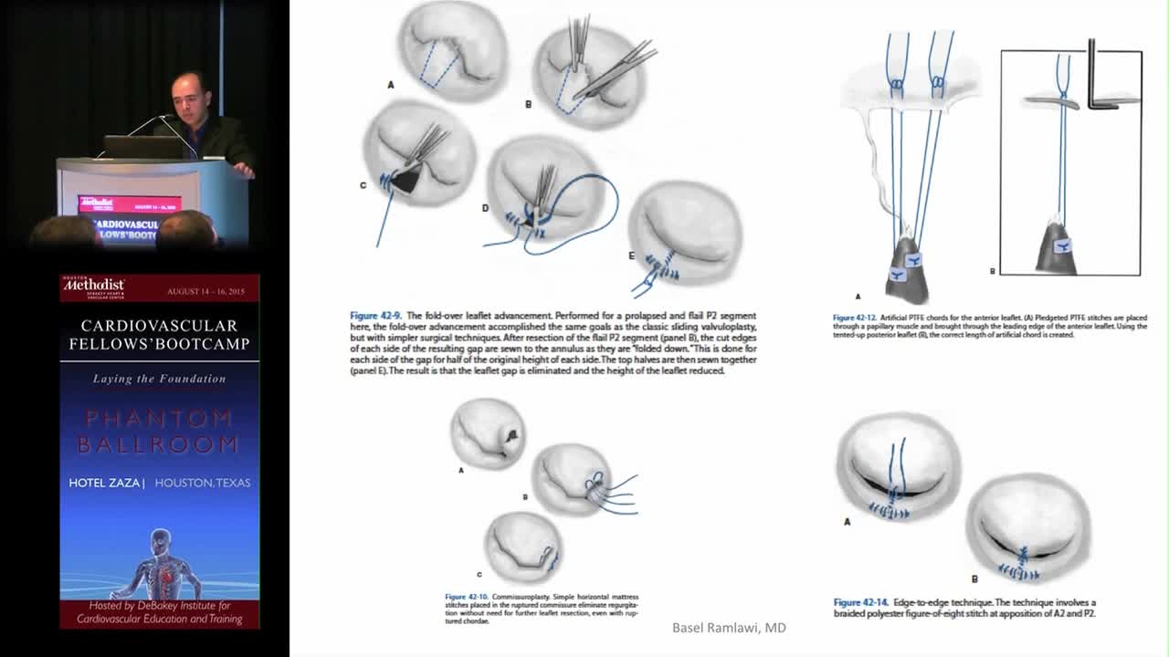 心瓣膜病手术（3）