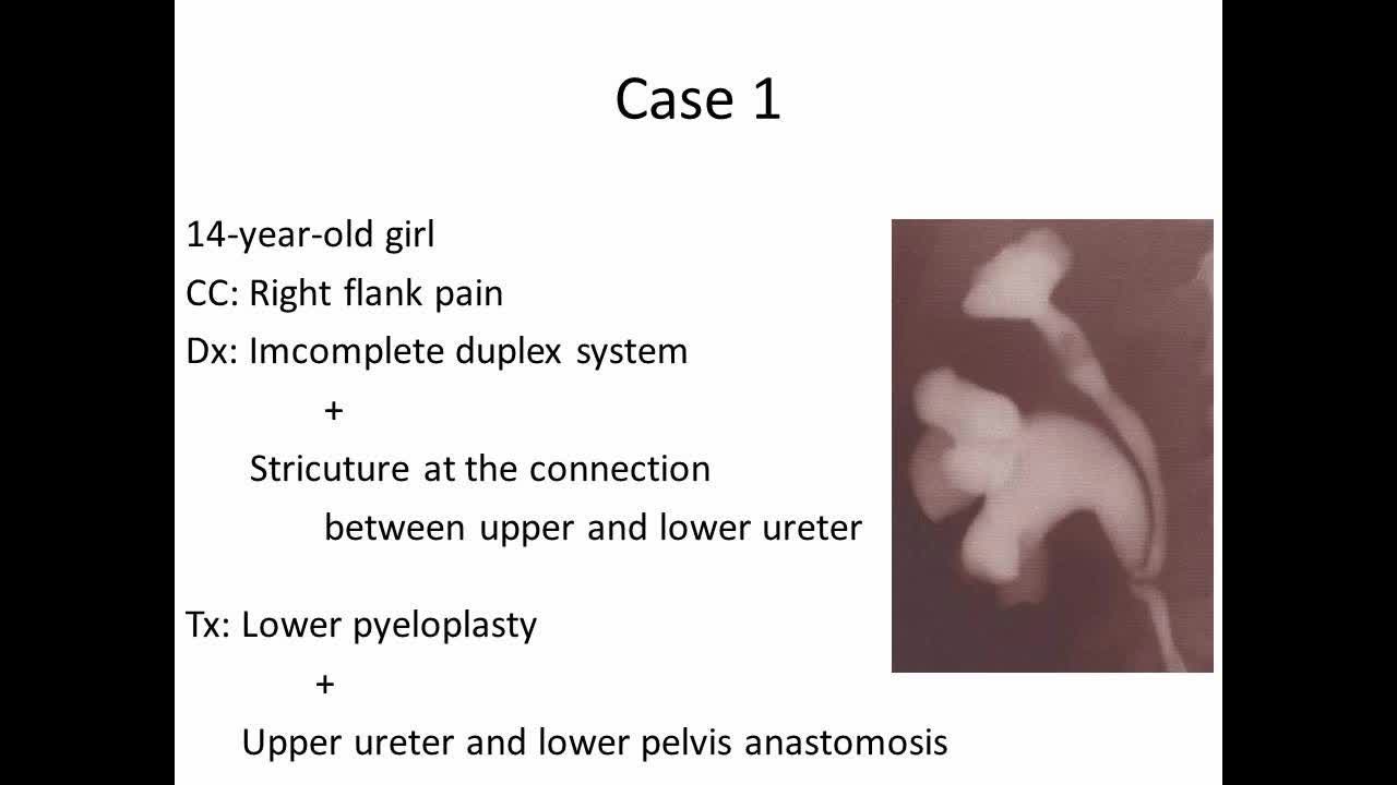 Laparoscopic management of duplicated collecting systems ..-