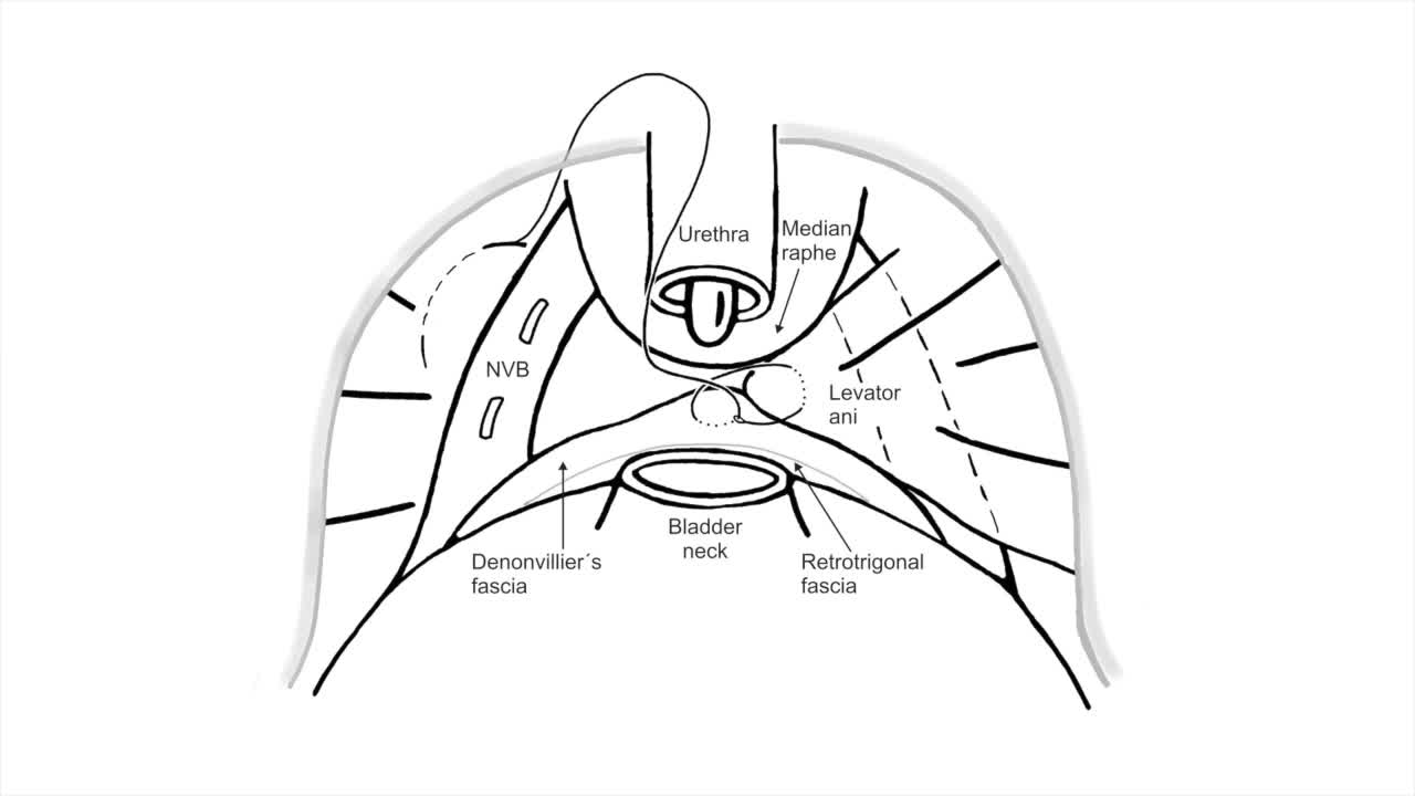 Robot-assisted functional reconstruction of urethral supp..-
