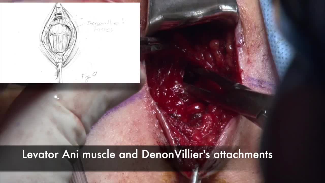 Robot assisted perineal radical prostatectomy in the sett..-