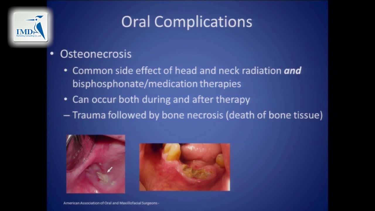 癌症治疗后如何管理牙齿健康（11）