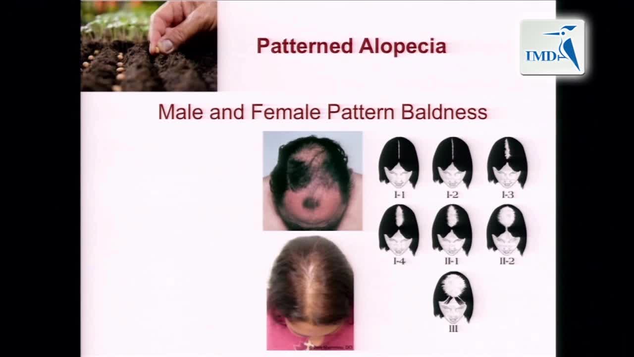 脱发的新兴治疗方法（7）