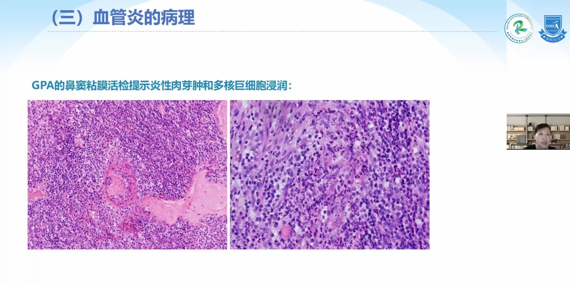 吴建红-原发性血管炎（2）