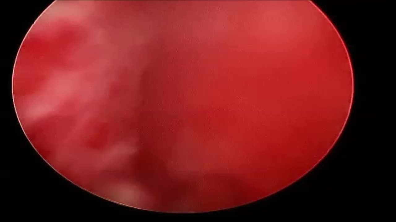 A novel one lobe technique of thulium, YAG laser enucleat..-