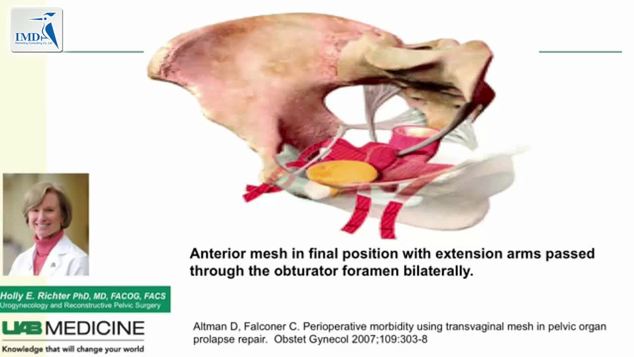 盆腔脏器脱垂手术介绍（4）