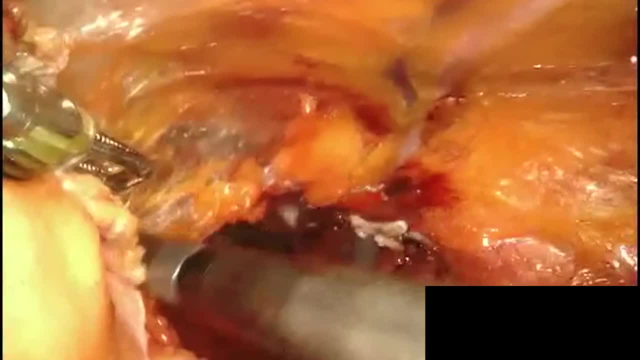 Robot-assisted partial cystectomy for the treatment of ur..-