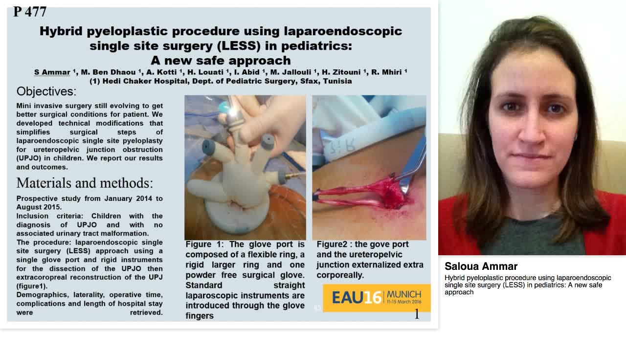 Hybrid pyeloplastic procedure using laparoendoscopic sing-