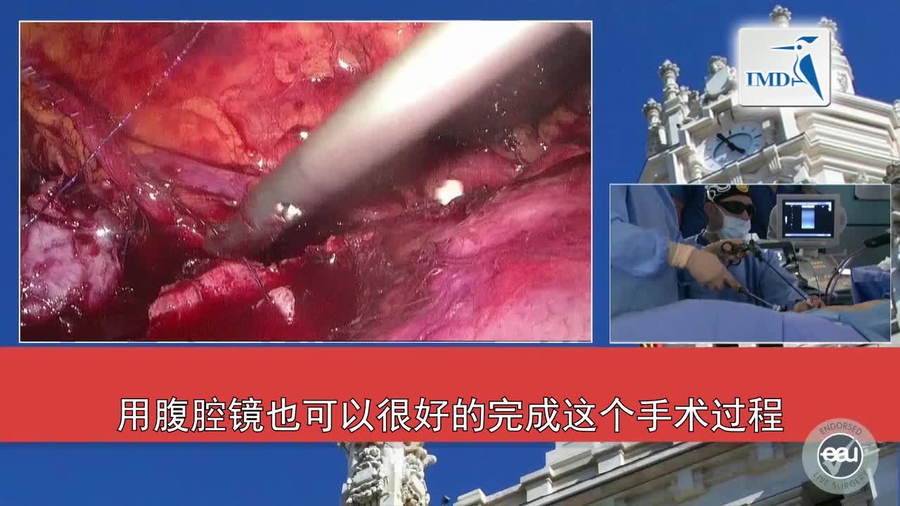 3D高清SPIES系统辅助腹腔镜部分肾切除术（4）