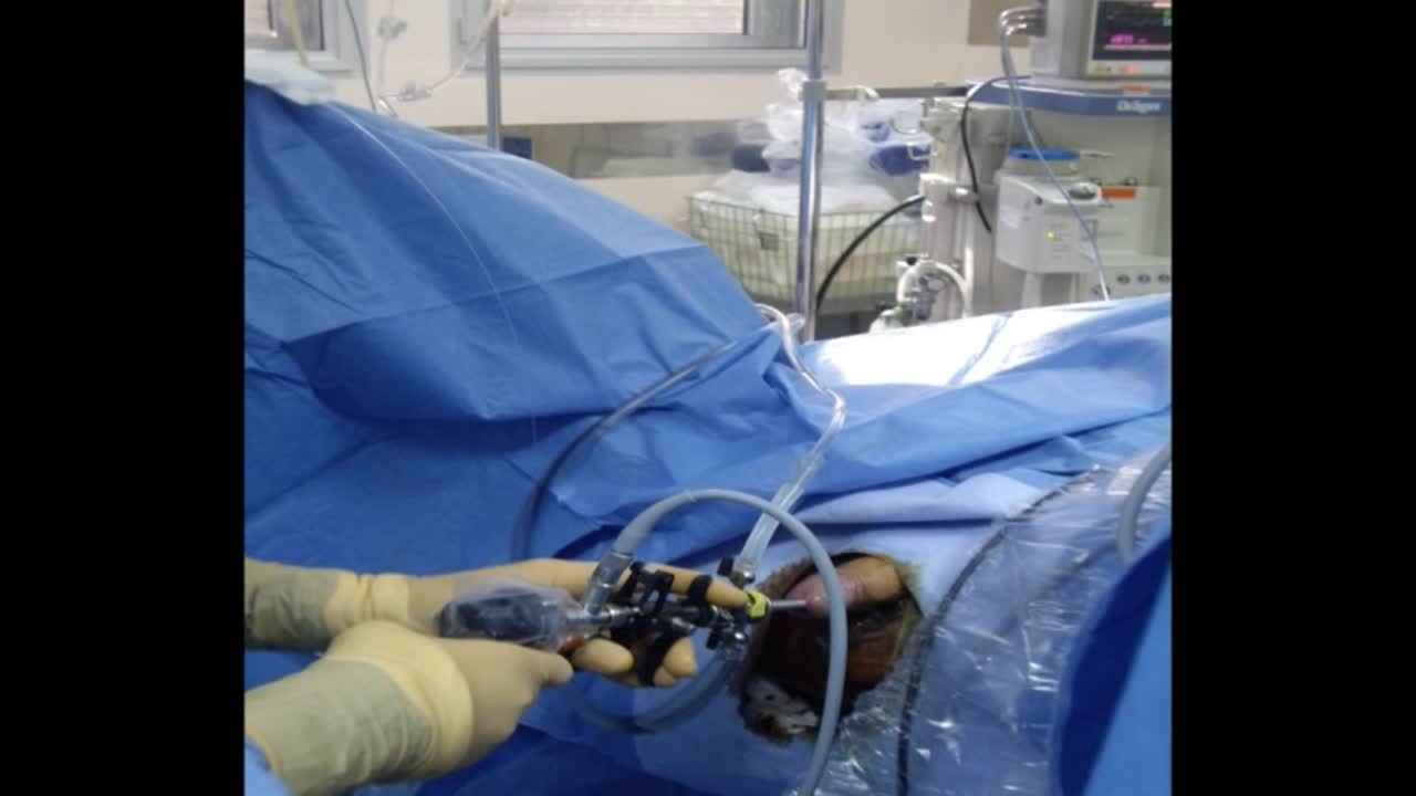 Complications of prostate enucleation and morcellation wi..-