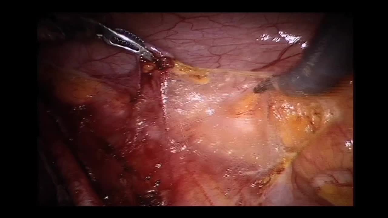 Robotic kidney transplantation, Our first case