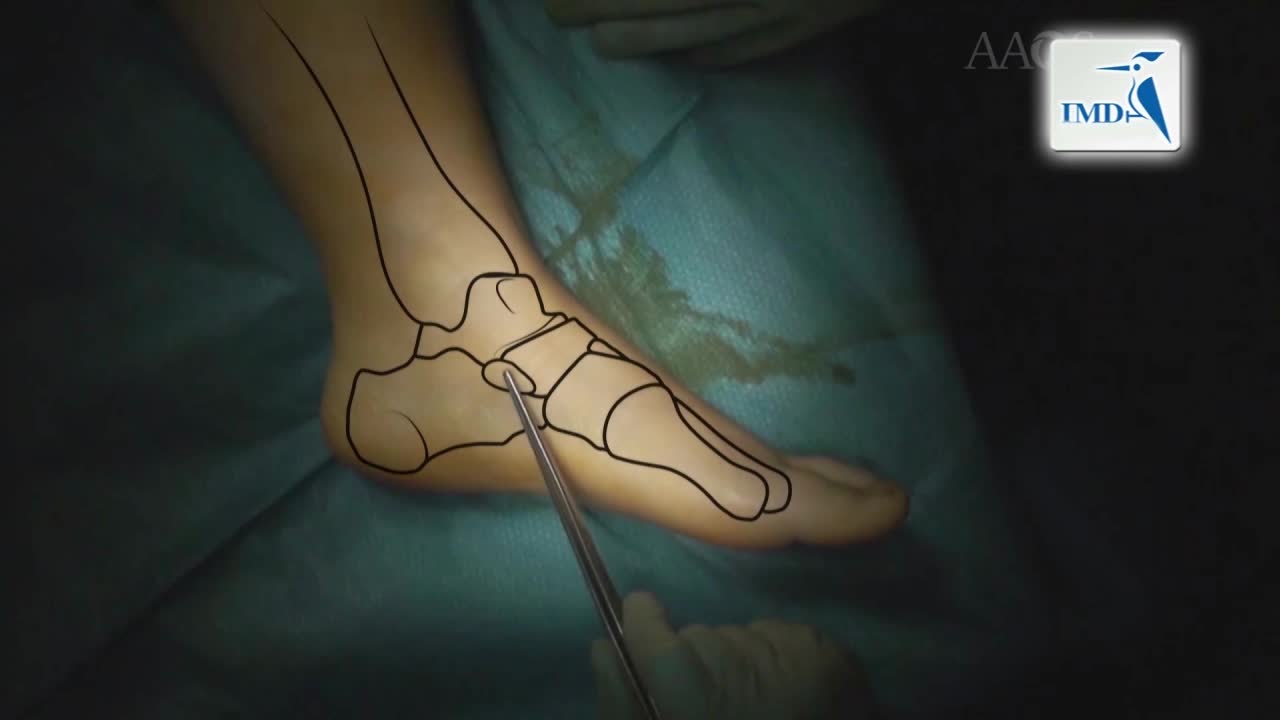 儿童易变性平足症的手术疗法（3）