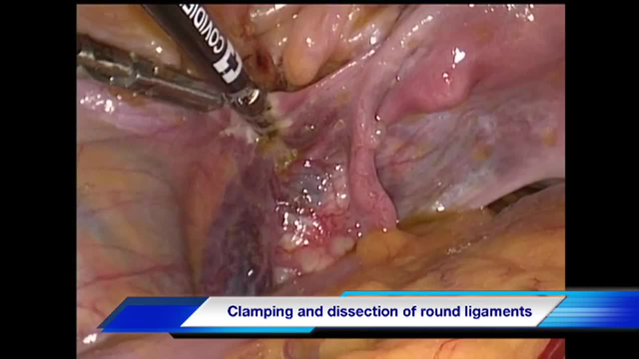 Ileal heterotopic Y'' shaped diversion following laparosco..-