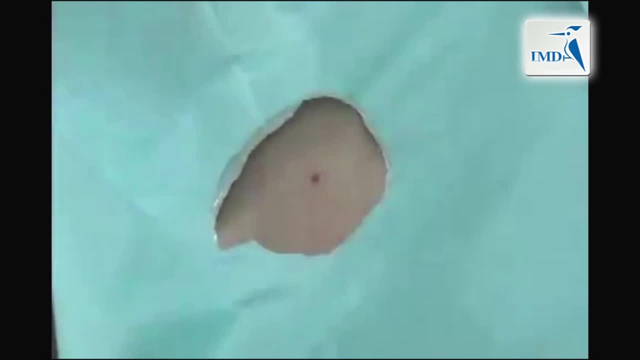 如何进行刮削活检