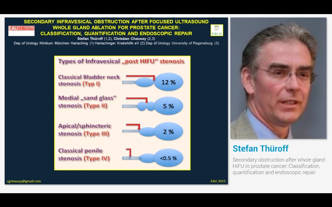 Secondary obstruction after whole gland HIFU in prostate ..-
