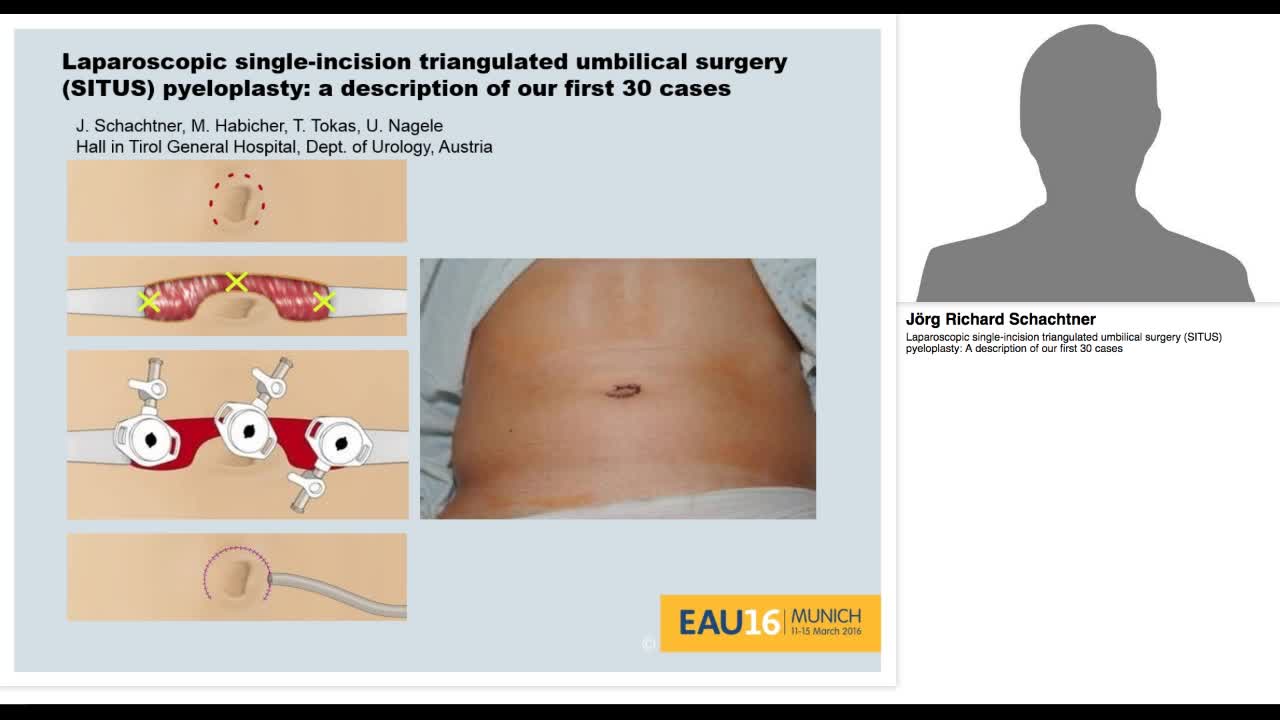 Laparoscopic single-incision triangulated umbilical surge-