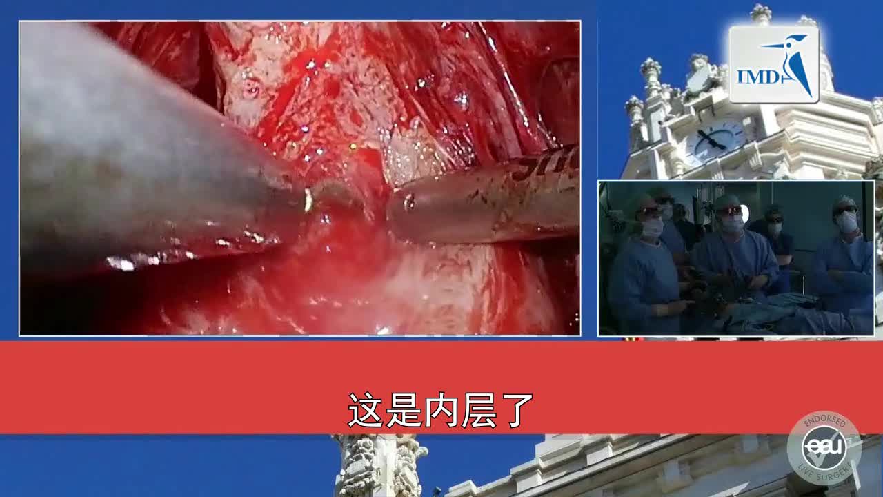 3D腹腔镜腹膜外根治性前列腺切除手术（5）