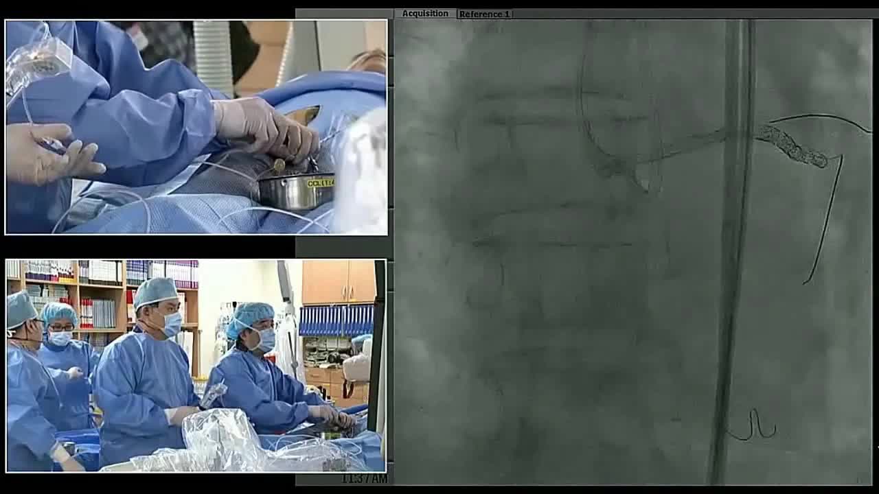 血管内手术现场案例一（5）