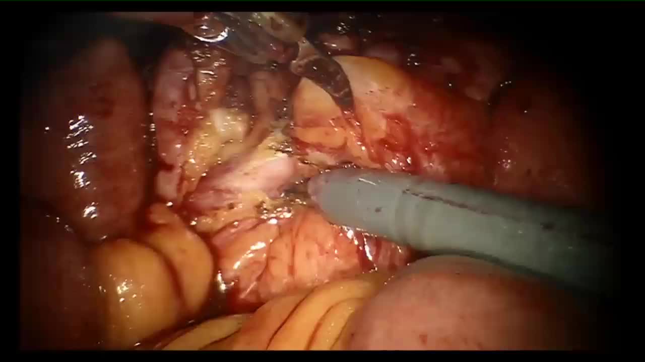 An innovative technique of robotic-assisted re-pyeloplast..-